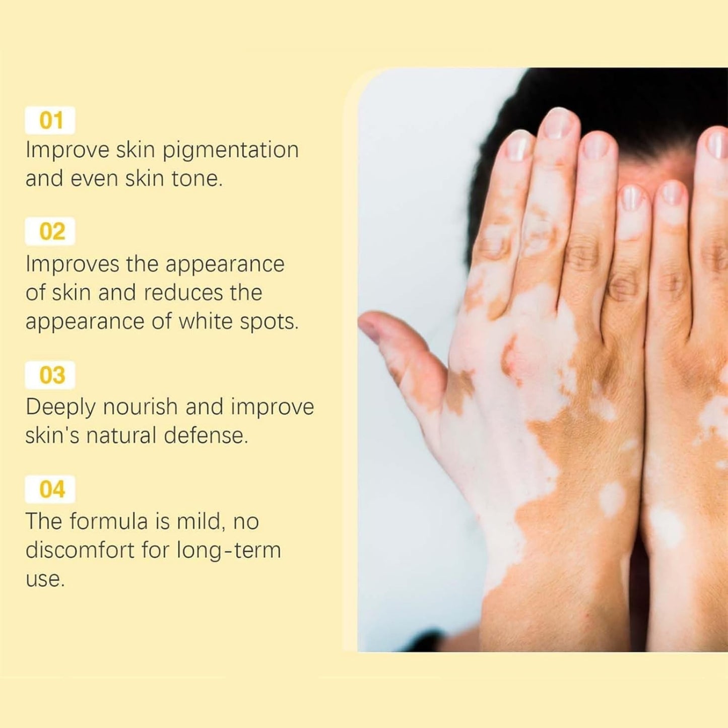 Vitigo Bee Venom Treatment Cream | Natural Skin Repair Hydration Relief Anti-Irritation